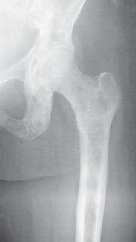 Illustration 18 for Advanced Arthroplasty for Malignant Lesions: Reclaim Your Mobility