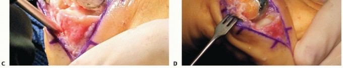 Illustration 40 for End Articular Cartilage Loss: Arthrosurface HemiCAP Resurfacing