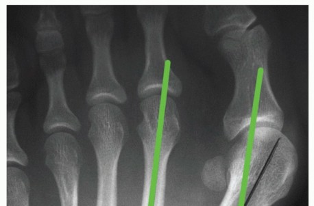 Extending the Indications: Simple Distal Chevron for Complex Bunions