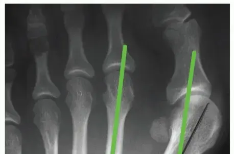 الورم الإبهامي (الوكعة): دليل شامل للعلاج والتعافي بتقنية الشفرون المعدلة مع الأستاذ الدكتور محمد هطيف