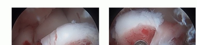 Illustration 5 for Treating Tibial Spine Fractures: Arthroscopy or Open Reduction?