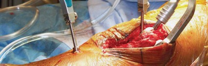 Illustration 23 for Optimize Tibial Component Alignment: Techniques for TKA Success