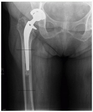 Revision THA: Why Extensively Porouscoated Cylindrical Stems Excel