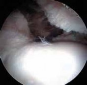 Illustration 28 for Resolving Femoral Head Neck Impingement: Arthroscopic FAI Solutions