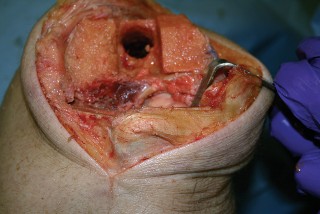 Illustration 27 for Understand Augments: The Role of Metal Augments in Arthroplasty