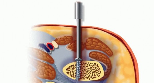 Illustration 3 for Retrograde Femoral Nailing: Optimizing Surgical Outcomes