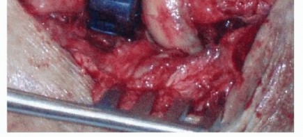 Illustration 26 for Restore Stability & Motion: Fixation of Fracture-Dislocations