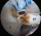 Illustration 17 for Arthroscopic Subscapularis Repair: The lo iky brady Method for Stability