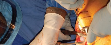 Illustration 25 for Mastering Gap Balancing in Revision TKA: Avoid Common Pitfalls