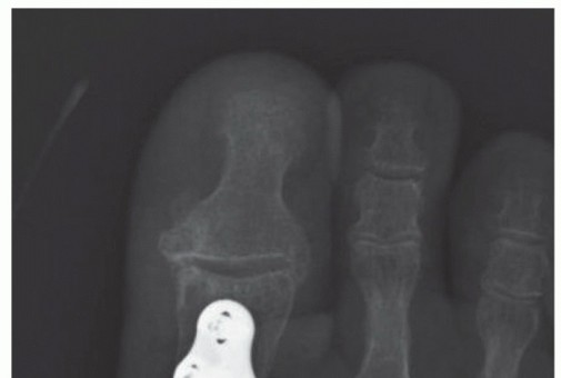 Illustration 11 for MTP Joint Arthrodesis: The Key to Optimal Toe Positioning