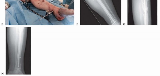 Illustration 33 for Advanced Nailing of the Mature Tibia: Overcoming Complexities