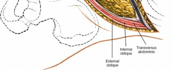 Illustration 16 for Master the Anterolateral Retroperitoneal Approach to Lumbar Spine