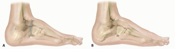 Illustration 8 for Expert Guide to Triple Arthrodesis et al. for Hindfoot