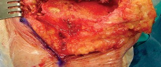 صورة طبية: مراجعة استبدال الركبة الجزئي الفاشل دليلك الشامل للعلاج الناجح في صنعاء