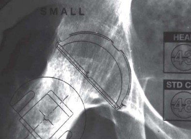 Illustration 3 for Unlock Movement: Arthroplasty for Bony Ankylosis Solutions