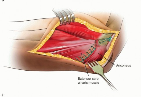 Illustration 26 for Radial Head Arthroplasty: Restoring Elbow Function & Stability