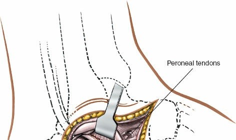 Illustration 115 for Optimized Approaches to the Dorsum of the Foot & Ankle
