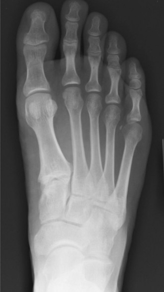 Medial and Lateral Foot Pain: Diagnosis & Imaging Insights