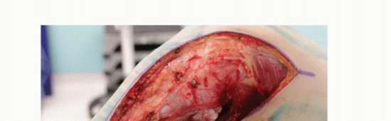 Illustration 19 for Tackling Complex Tumors of the Proximal Tibia: Limb-Sparing Solutions