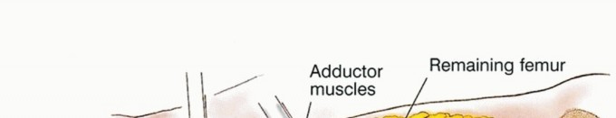 Illustration 31 for Beyond Amputation: Total Femur Resection with Endoprosthetics