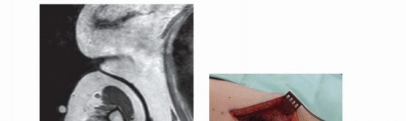 Illustration 11 for Targeted Ablation of Musculoskeletal Tumors: A Safer Approach