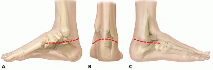 Illustration 7 for Resistant Clubfoot Solved: Posteromedial and Posterolateral Release