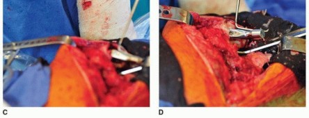 Illustration 13 for Cement in Cement Revision: Simplifying Complex Hip Revisions
