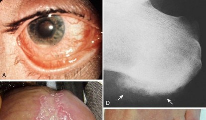 Illustration of crystal deposition arthropathy - Dr. Mohammed Hutaif