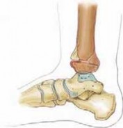 Illustration 16 for Pediatric Ankle Fractures: Management to Prevent Long-Term Issues