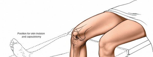 Illustration of parapatellar approach medial - Dr. Mohammed Hutaif