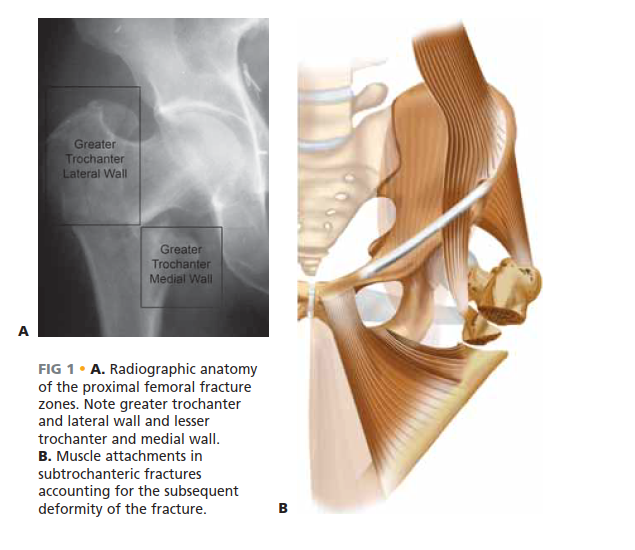 Illustration of nailing of the proximal - Dr. Mohammed Hutaif