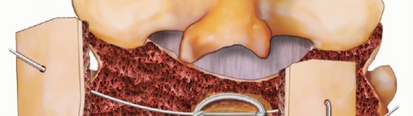 Illustration 10 for Achieve Stability: Posterior Cervical Lateral Mass Screw Fusion
