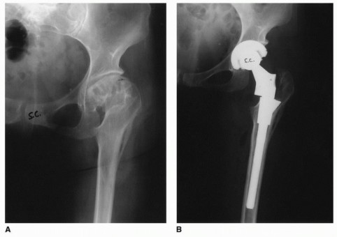 Illustration 28 for Recreate Hip Biomechanics: Modular Stems for Modular Solutions