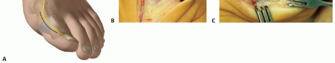 Illustration 4 for Mastering Extensive Plantar Release for Hallux Rigidus