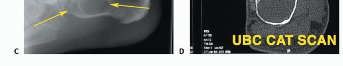 Illustration 12 for Treating Tumors of the Foot: Optimizing Amputation & Resection