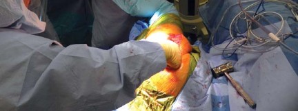 Illustration 10 for Unlock better THA: The technique of short stem for less invasiveness