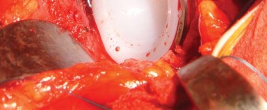 Illustration 19 for Posterolateral Surgical Approaches: Achieve Optimal Hip Replacement