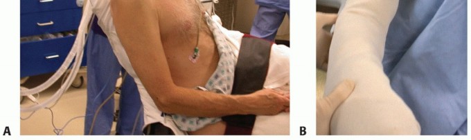 Illustration 6 for Subscapularis & Teres Rotator Cuff Repair: Advanced Techniques