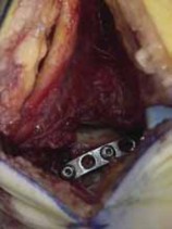 Illustration 31 for Talar Neck Fracture Treatment: Optimizing Recovery with ORIF