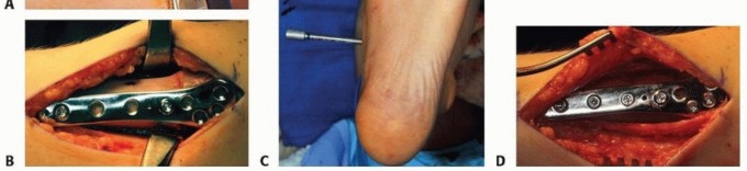 Illustration 14 for Distal Tibial Osteotomy: Fixing Varus & Valgus Ankle Alignment