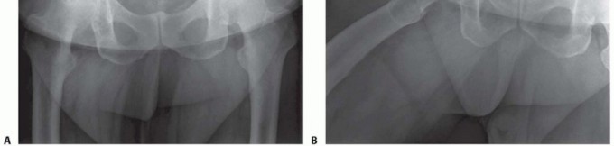 Illustration 11 for Anterior FAI Relief: Mini-Open Anterior Approach Explained