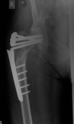 Illustration 3 for Lower Limb Trauma: Decipher Anteroposterior (AP) Figure for Exams
