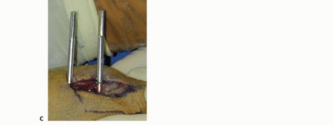 Illustration 21 for Effective K-Wire Fixation: Distal Radius Fractures Without External Fixation