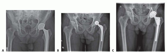 Illustration 3 for Hip Reimplantation Surgery: The Solution for Infected Implants