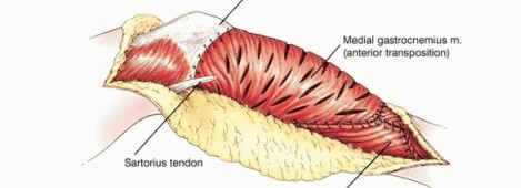 Illustration 39 for Tackling Complex Tumors of the Proximal Tibia: Limb-Sparing Solutions