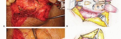 Illustration 35 for Sacral Tumor Surgery: Safeguarding Bowel & Bladder Control