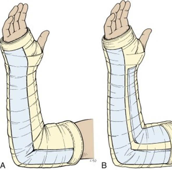 Orthopedic Splinting Mastery: Treating a Condition Where Damage Occurs