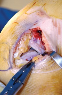 صورة طبية: جراحة استبدال مفصل الركبة الجزئي (UKA): تجنب الأخطاء والاستفادة القصوى في صنعاء مع الأستاذ الدكتور محمد هطيف