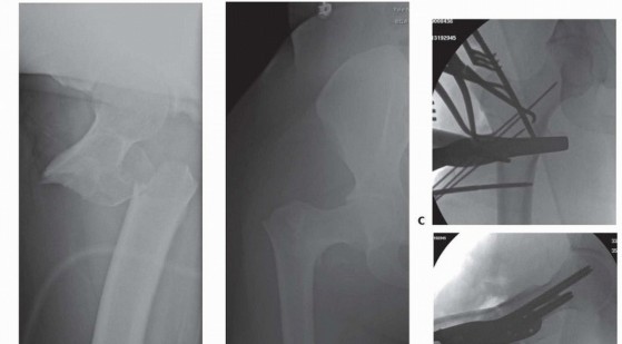 Illustration 19 for ORIF for Peritrochanteric Hip Fractures: Achieve Stable Mobility