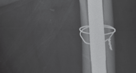 Illustration 57 for Femoral Stem Revision: Posterior Approach for Better Outcomes